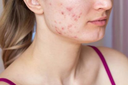 An easy skin care product guide to treating acne-prone skin